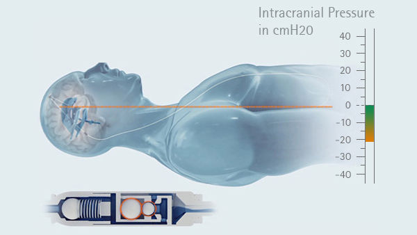 Grafico della pressione intracranica in posizione orizzontale