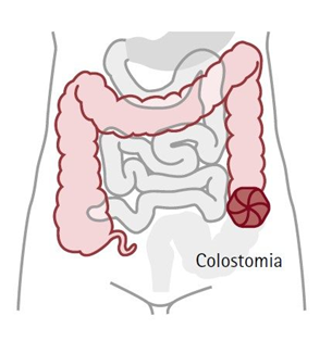 illustrazione della colostomia e ileostomia